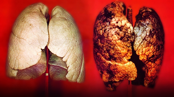 rak płuc objawy zdjęcie
