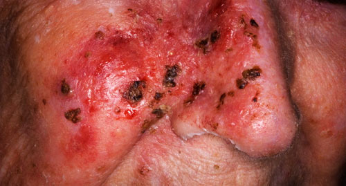 rak skóry na twarzy (czerniak)