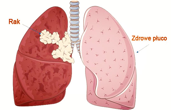 rak płuc przerzut na zdrowe płuco
