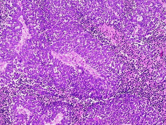 drobnokomórkowy rak płuc pod mokroskopem