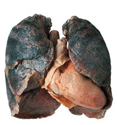 zdjęcie raka płuc