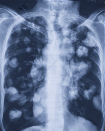 RTG - mnogie przerzuty nowotworowe na płucach 