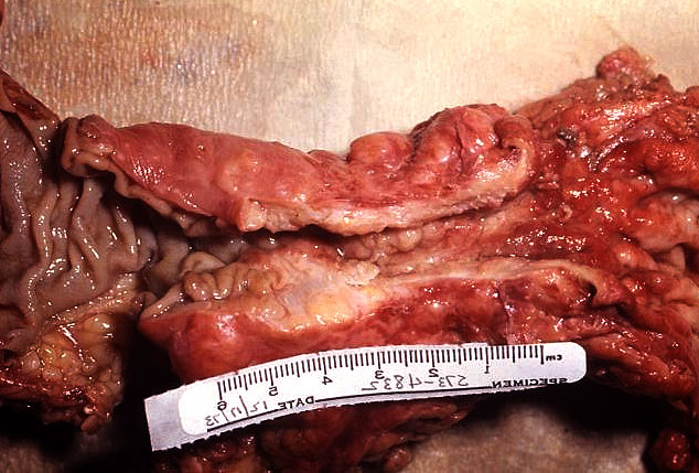 zdjęcie zaawansowanego raka jelita grubego